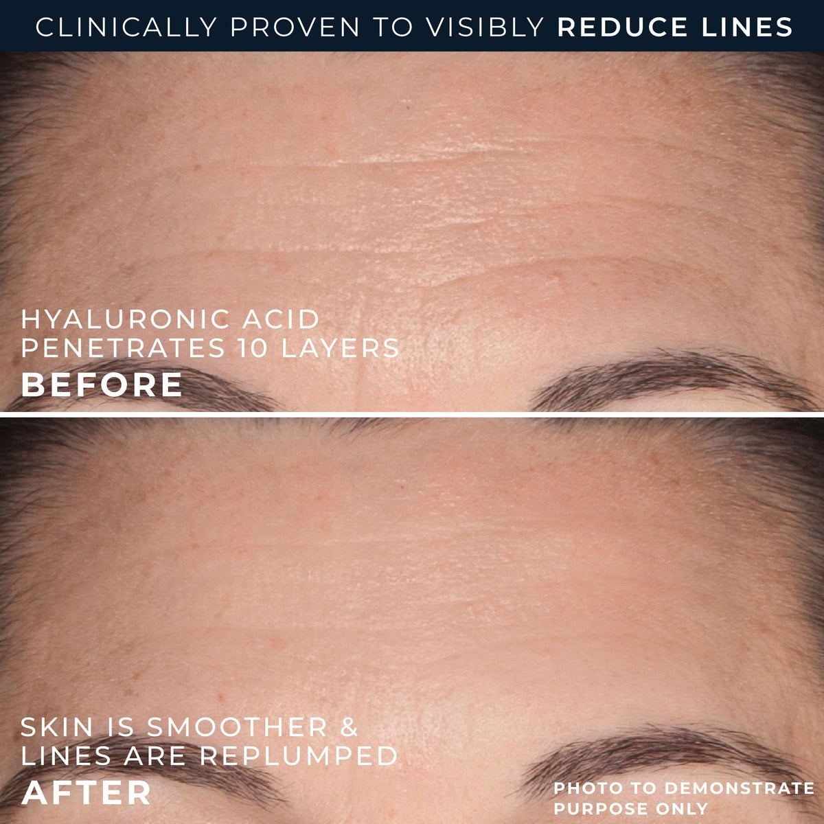 RoC serum applied to forehead demonstrating targeted plumping and smoothing