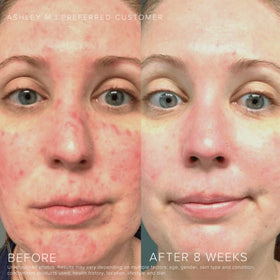 RODAN + FIELDS applying sunscreen to face demonstrating gentle daily protection benefit