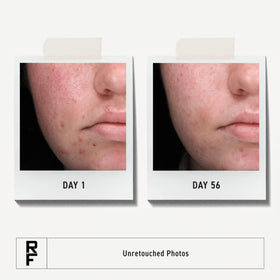 Rodan + Fields acne wash pump close-up showing easy dispensing and gentle cleansing