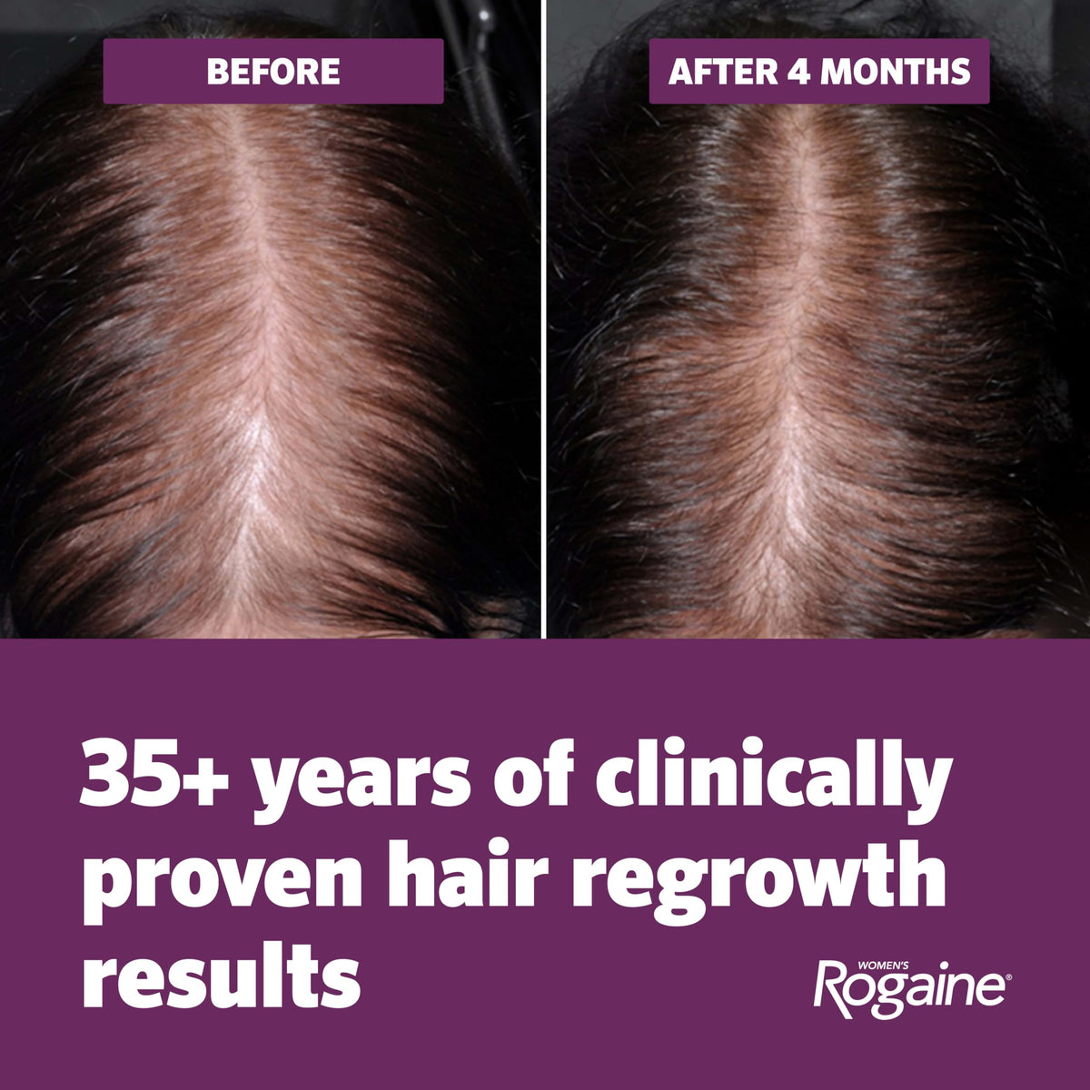 Rogaine applied to scalp demonstrating targeted application benefit