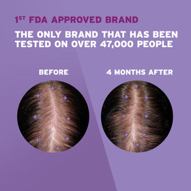 Rogaine dropper applying solution to scalp for targeted regrowth care