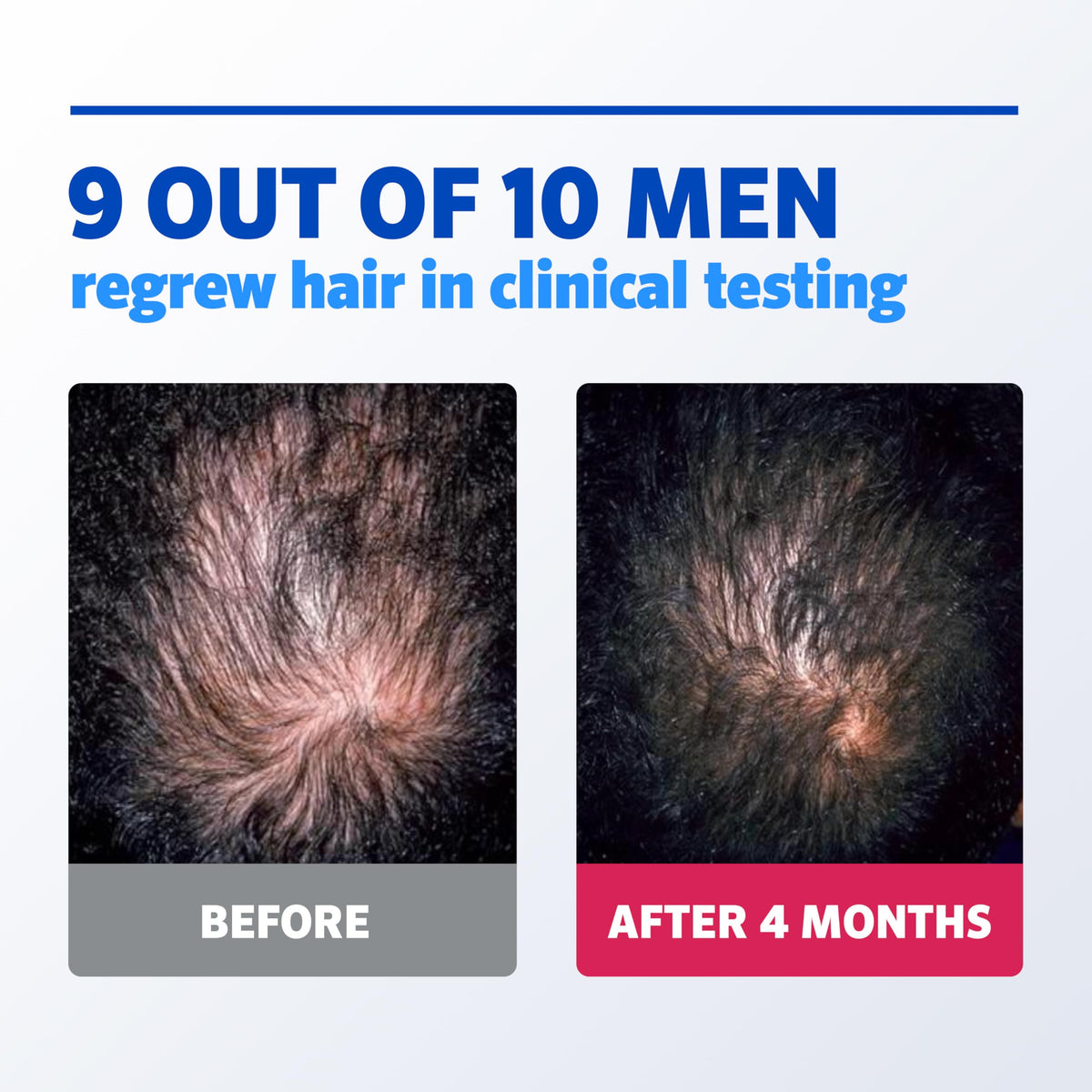 Rogaine foam applied to scalp showing targeted thinning hair treatment