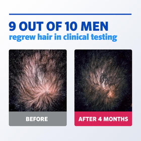 Rogaine foam applied to scalp showing targeted thinning hair treatment