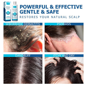 Roycederm before-and-after scalp visual illustrating reduced visible flaking