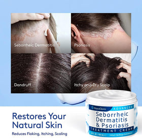Roycederm bundle scalp application demo illustrating targeted flare use