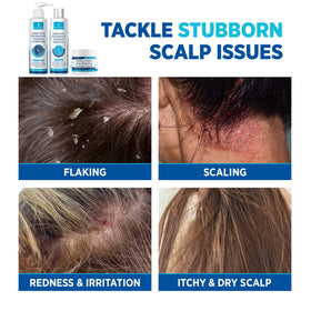 Roycederm cream applied to scalp spot demonstrating precise, soothing application