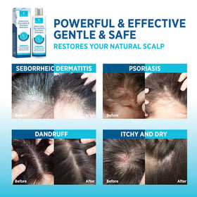 Roycederm treated scalp before and after image, reduced flaking benefit