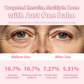 Saitir sak used on lips and smile lines showing targeted moisture and softer-looking lines