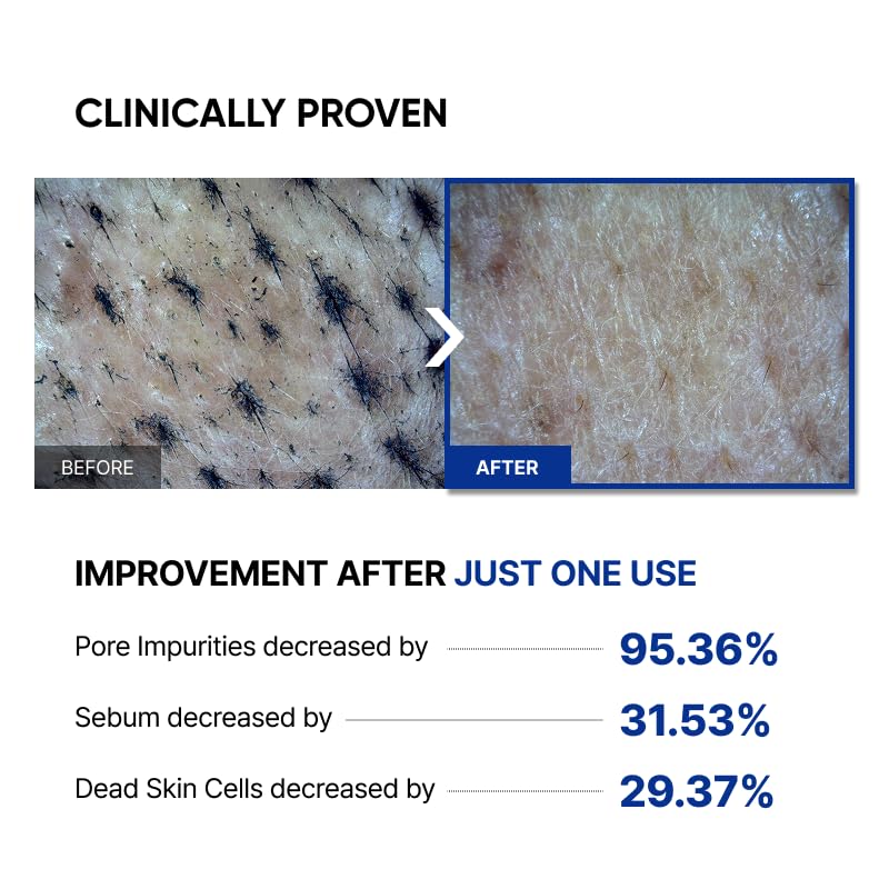 SAYNID before and after pores showing refined texture and smoother skin finish