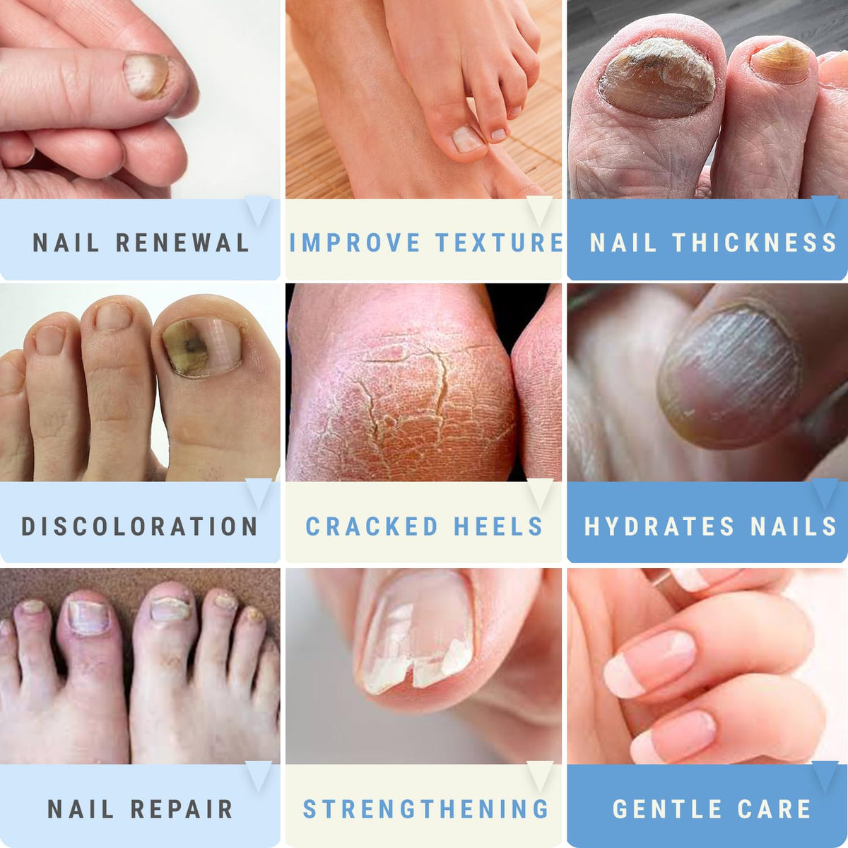 Scientific Solutions Global gel applied to toenail indicating visible softening