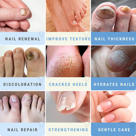 Scientific Solutions Global gel applied to toenail indicating visible softening