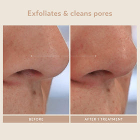 SHANI DARDEN acid applied to cheek illustrating targeted exfoliation benefit