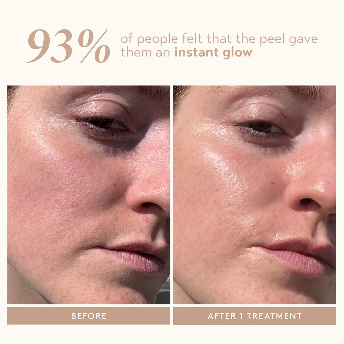 SHANI DARDEN peel being applied to cheek showing controlled exfoliation
