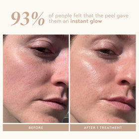 SHANI DARDEN peel being applied to cheek showing controlled exfoliation