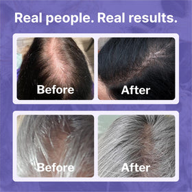 Shapiro MD applying serum to scalp demonstrating targeted delivery