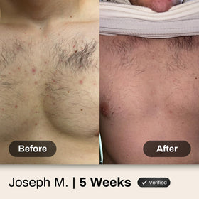 Shield in-shower use on back demonstrating targeted acne cleansing