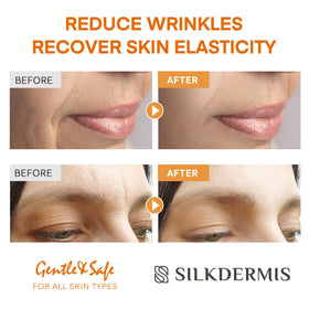 SILKDERMIS under-eye patch in use illustrating gentle crease reduction