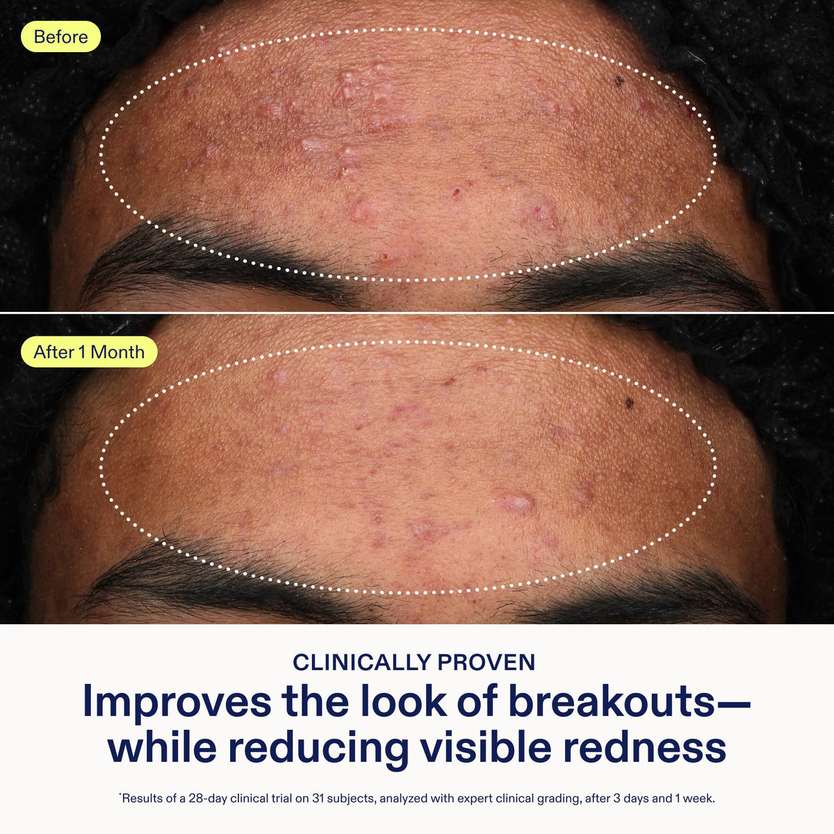 Skinfix ingredient label close-up listing Adapinoid, niacinamide, hyaluronic acid