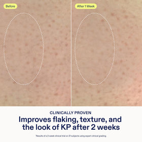 Skinfix ingredient display with acids and squalane, communicates gentle resurfacing benefit