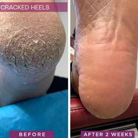 SkinIntegra being applied to cracked heel to relieve discomfort