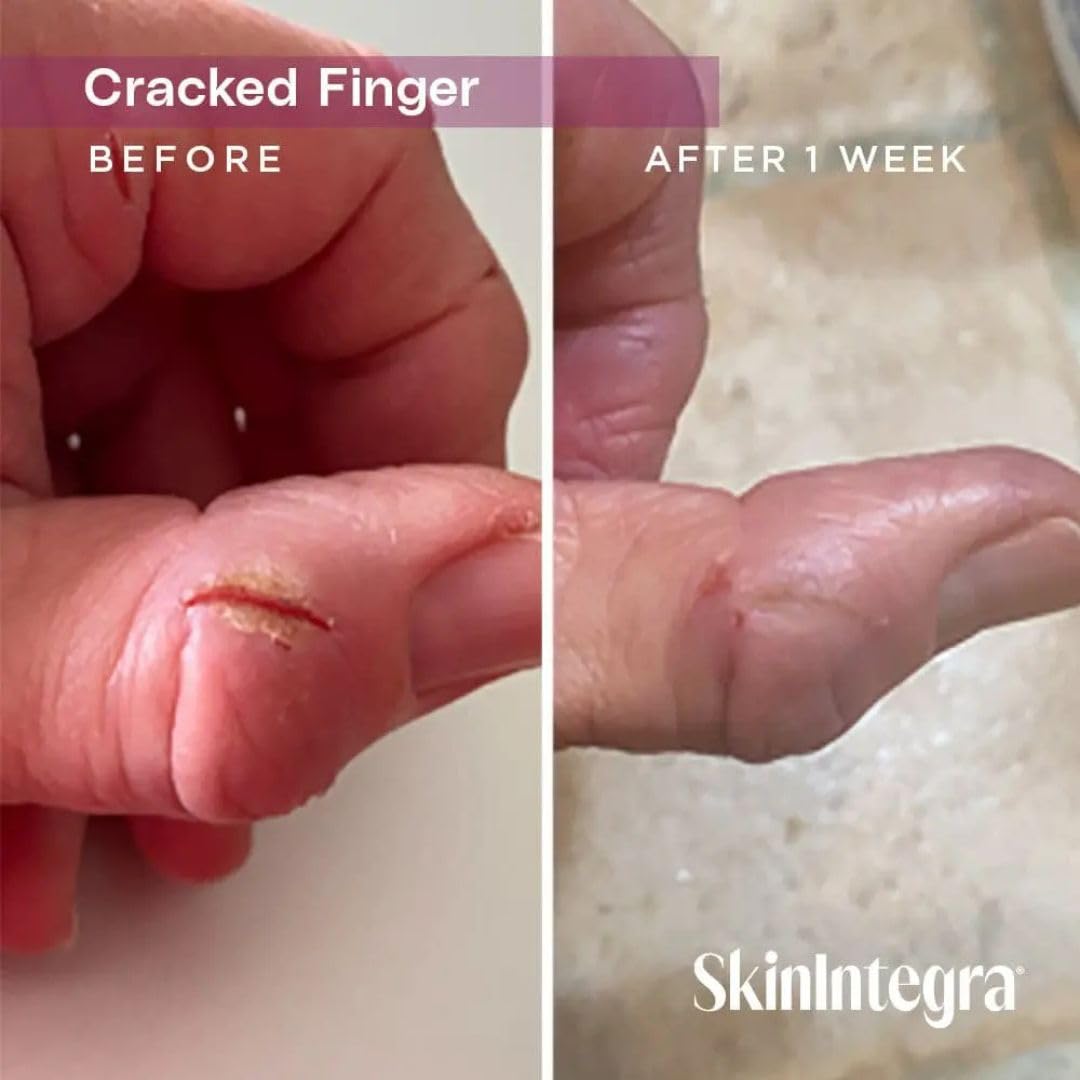 SkinIntegra tube held in hand showing compact 3 oz size