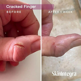SkinIntegra tube held in hand showing compact 3 oz size