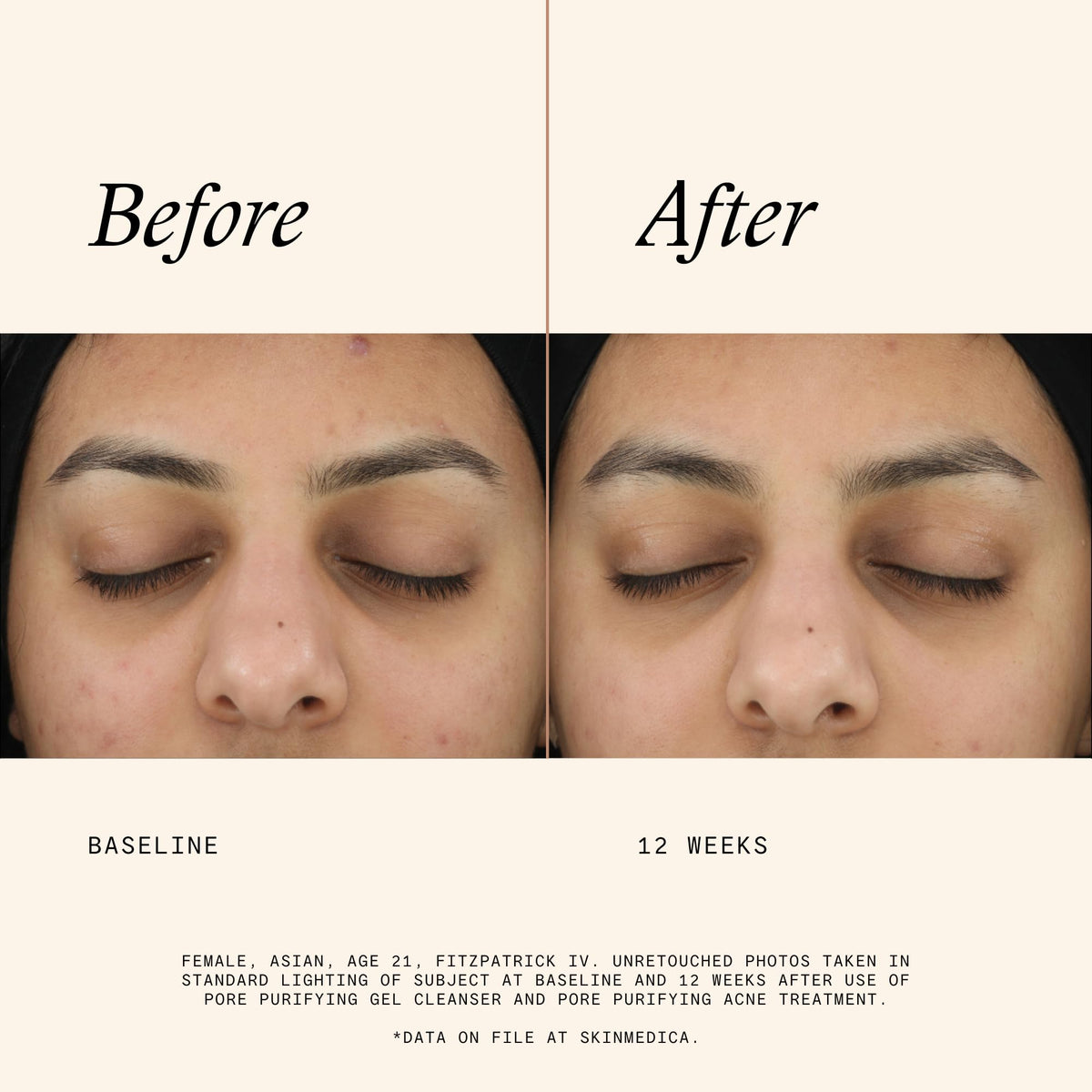 SkinMedica label close-up listing key ingredients and proven exfoliant benefits
