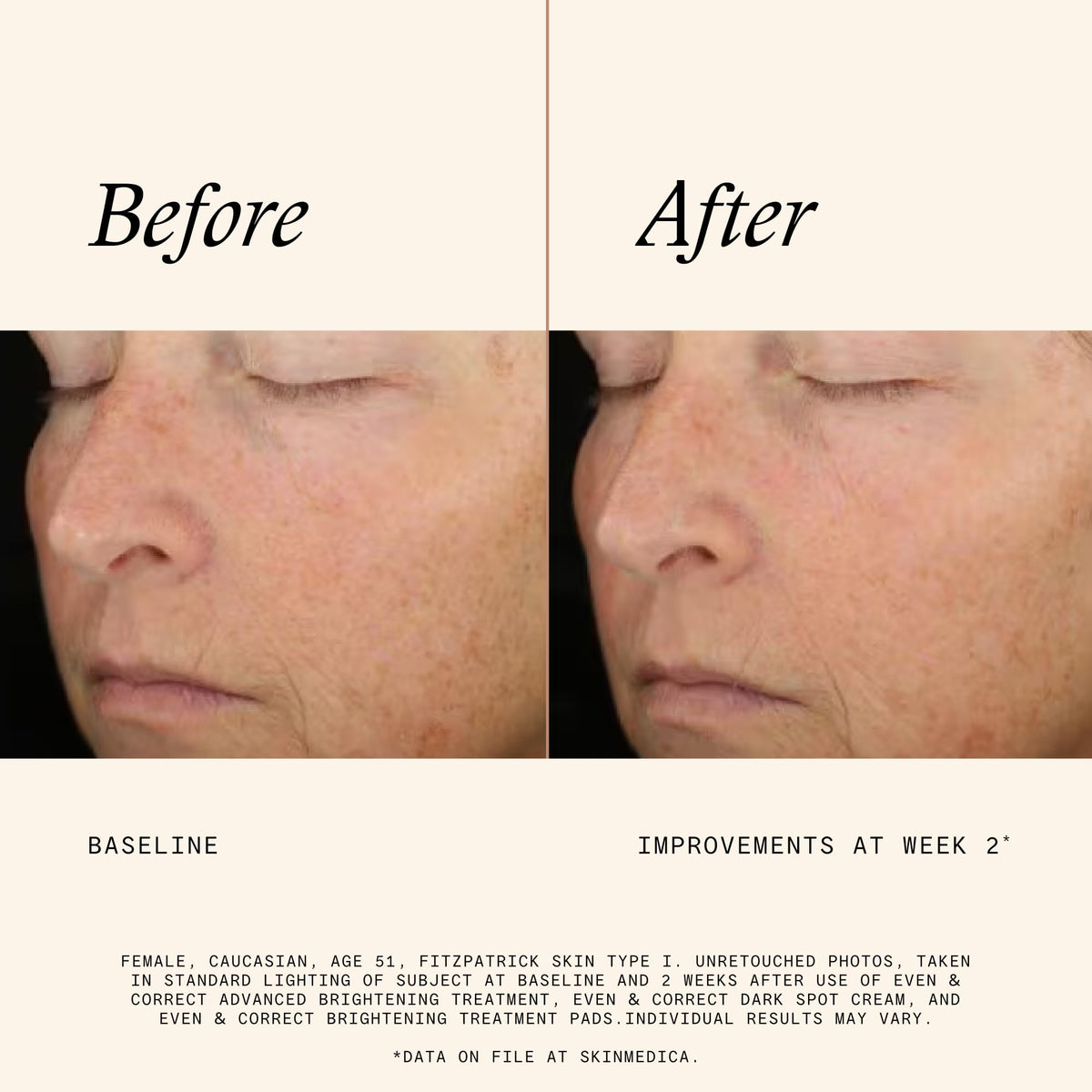 SkinMedica pad being applied by hand to show ease and safe application