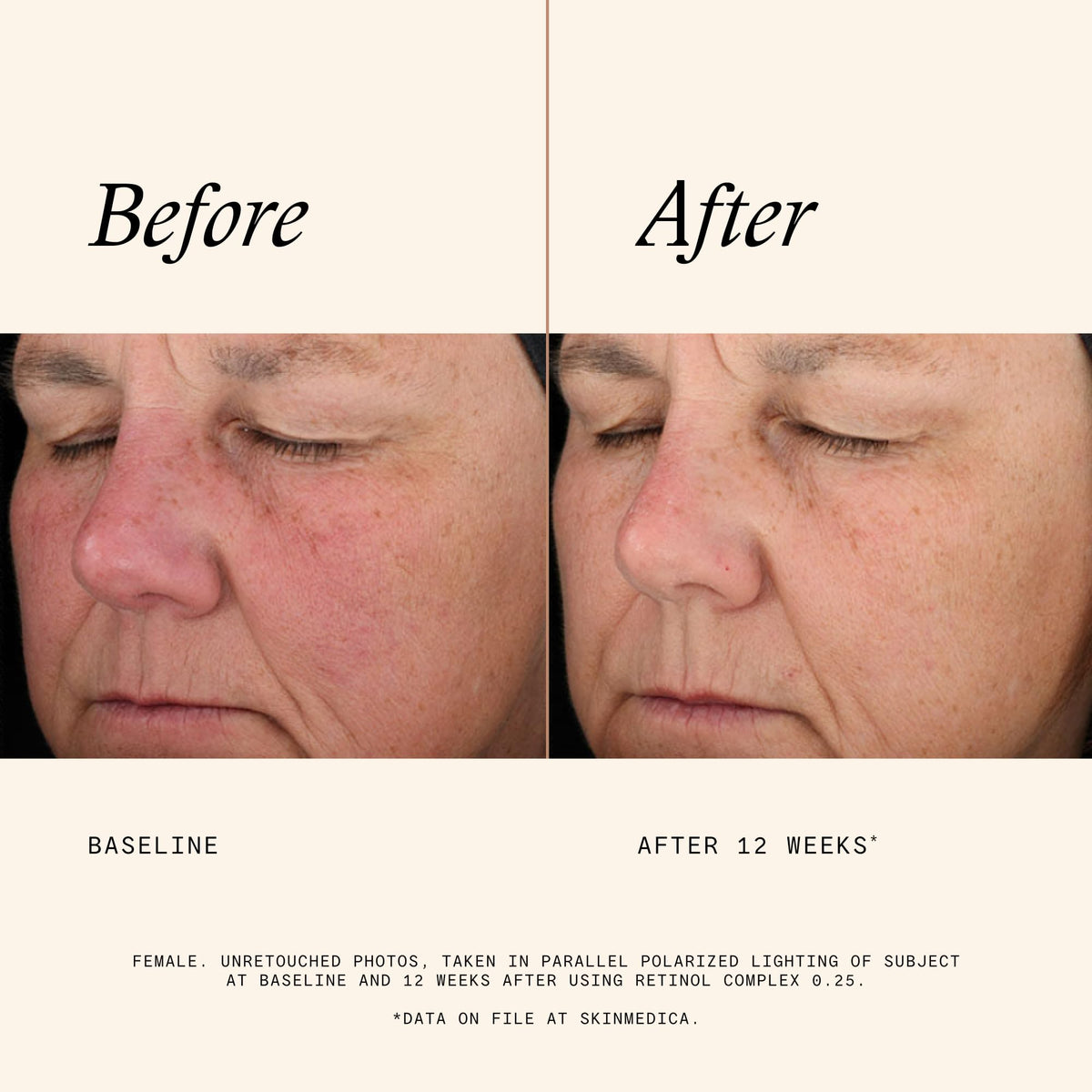 SkinMedica retinol 0.25 label detail and pump emphasizing ingredient clarity