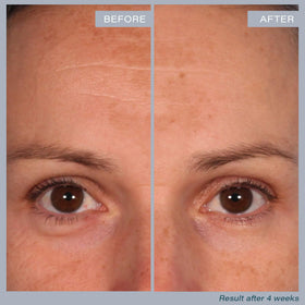 SKINN pad in hand applying to cheek demonstrating easy at-home exfoliation
