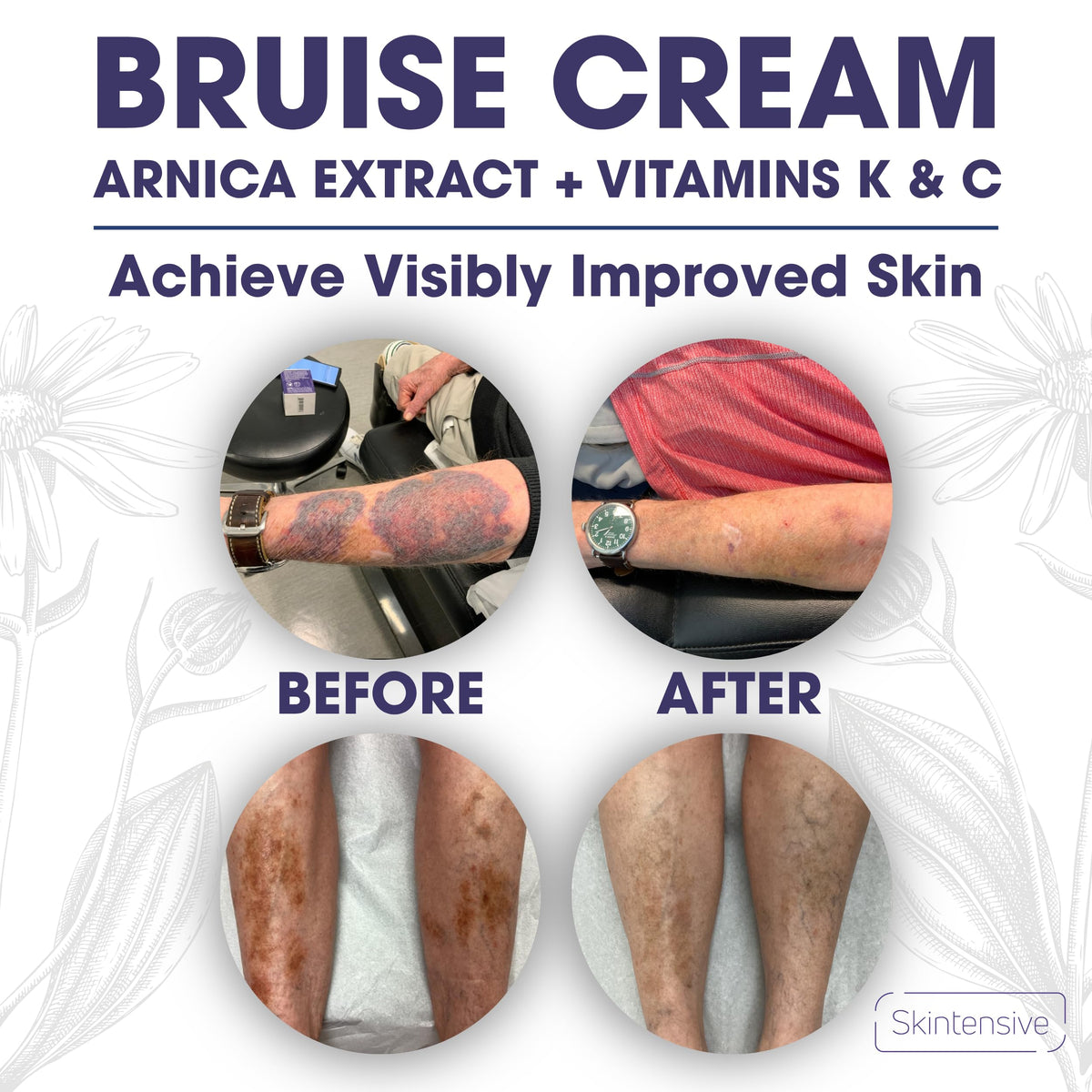 SKINTENSIVE label close-up highlighting arnica and vitamins K C E ingredients