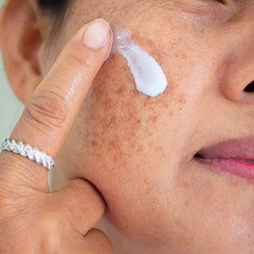 Skinuva Brite dabbed on acne scar showing targeted spot-fading benefit