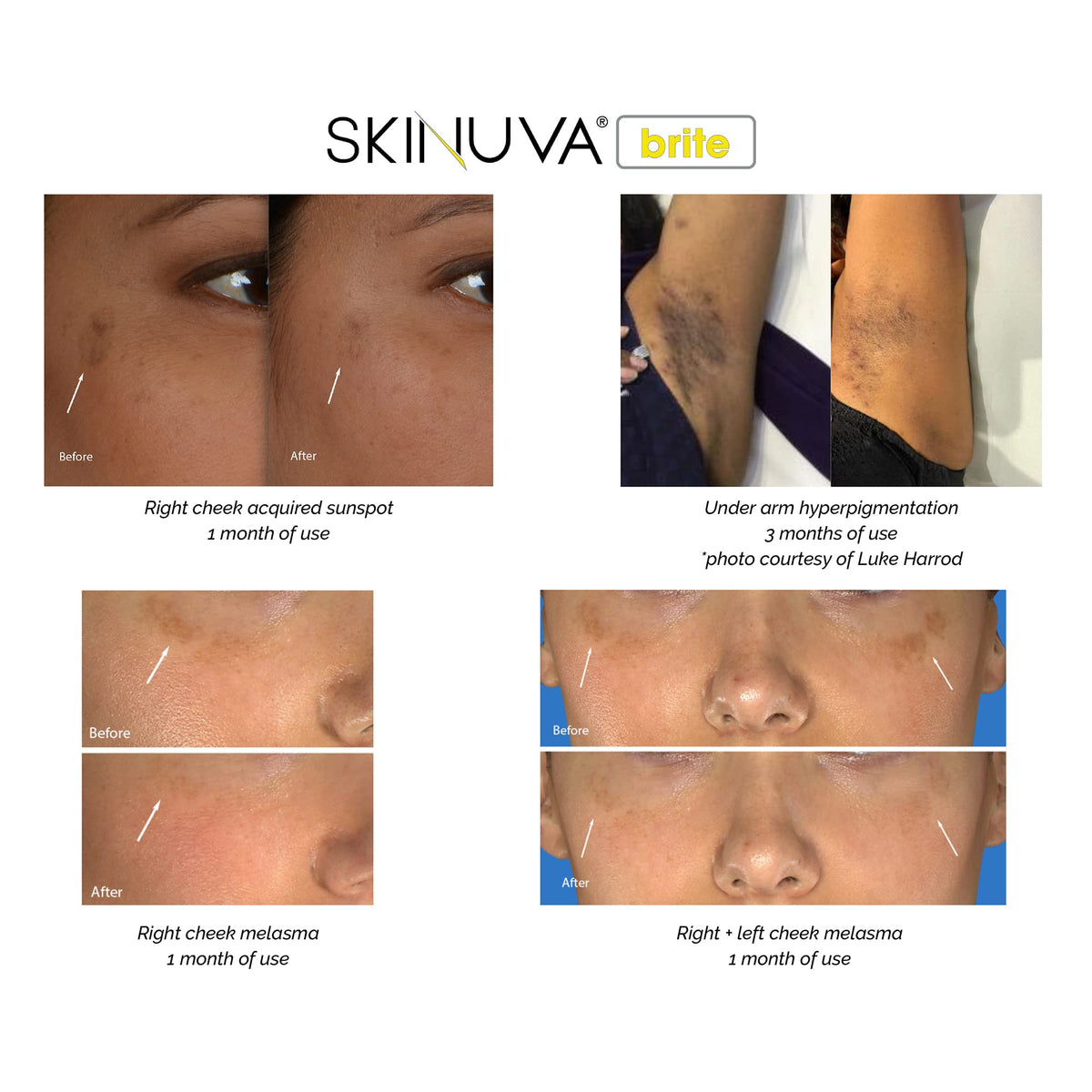 Skinuva Brite cap and nozzle close-up showing precise application benefit