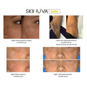 Skinuva Brite cap and nozzle close-up showing precise application benefit