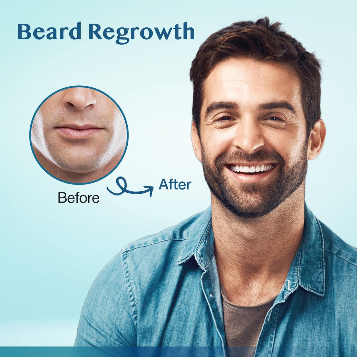 Stafenit used on beard area demonstrating targeted regrowth application for fuller look