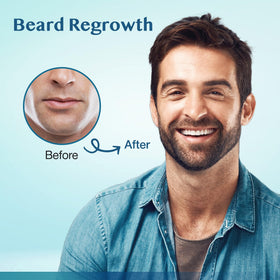 Stafenit used on beard area demonstrating targeted regrowth application for fuller look