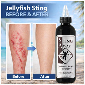 Sting Away applied to swimmer on beach easing pain after jellyfish sting