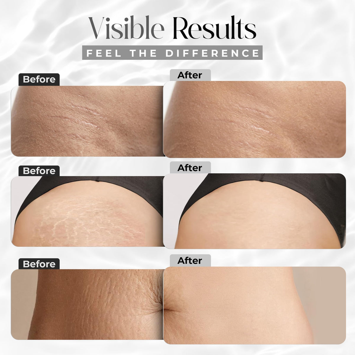 StretchMarkers being applied to a thigh demonstrating targeted treatment and smoothing effect