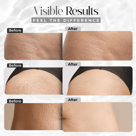 StretchMarkers being applied to a thigh demonstrating targeted treatment and smoothing effect