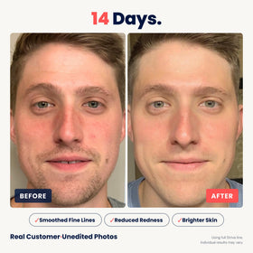 Strive before after scale showing improved texture and reduced pores