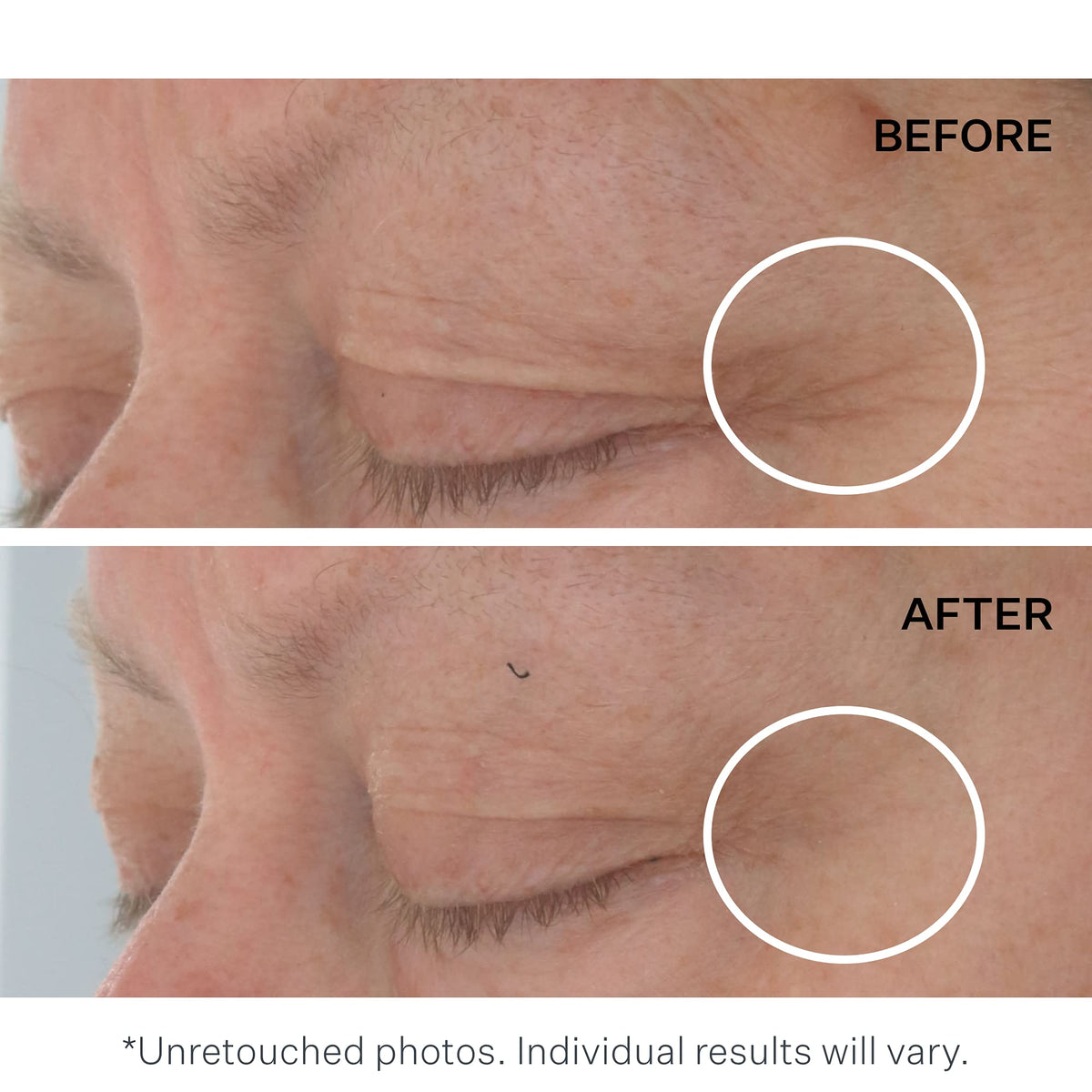 StriVectin before and after under-eye comparison illustrates visible smoothing effect