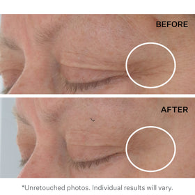 StriVectin before and after under-eye comparison illustrates visible smoothing effect