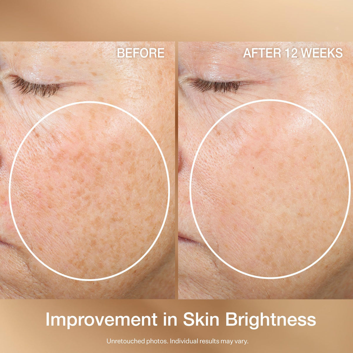 StriVectin used on neck and décolleté showing smoothing and texture improvement