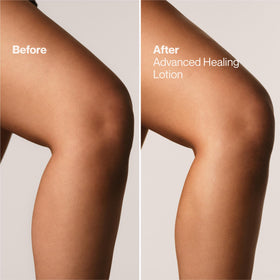 Suave before and after on elbow showing smoother, hydrated skin