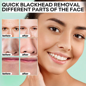 SYABO application on nose demonstrating targeted blackhead removal