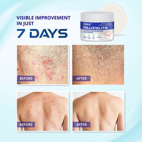 TAGRID used on scalp in bathroom setting for calming follicle irritation