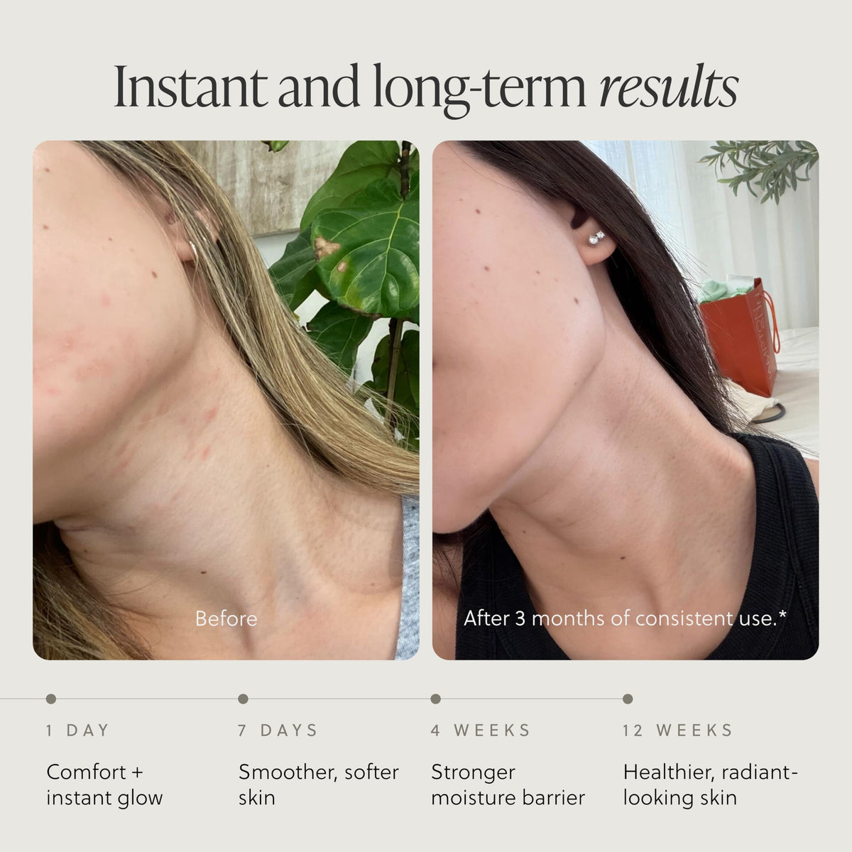 Before and after elbow application with TALOVA, shows smoother skin benefit
