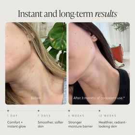 Before and after elbow application with TALOVA, shows smoother skin benefit