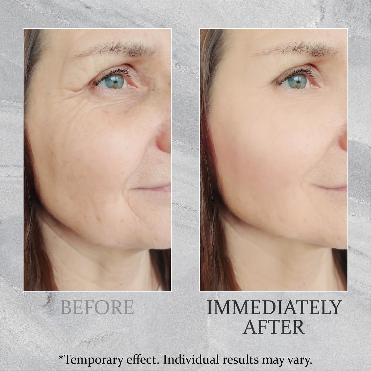 TEULN applied along jawline demonstrating lifting and contouring effect