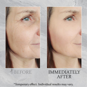 TEULN applied along jawline demonstrating lifting and contouring effect